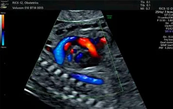 Ecocardiograma fetal com doppler à cores
