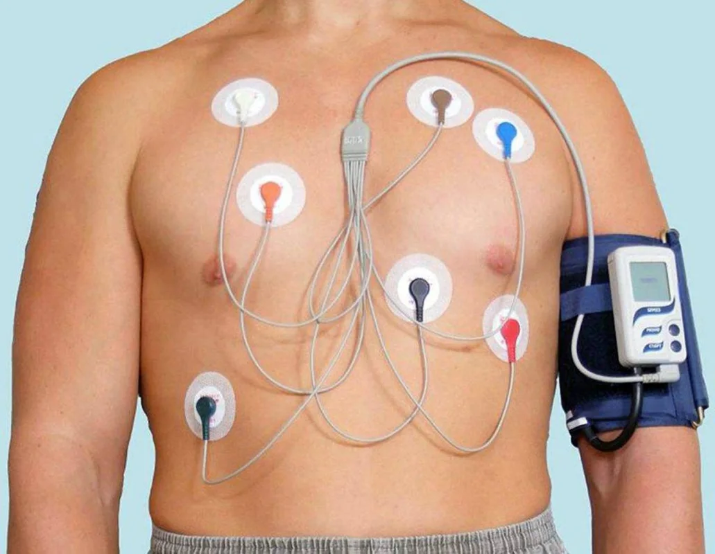Holter de 48 horas