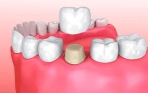 Coroa total sobre dente